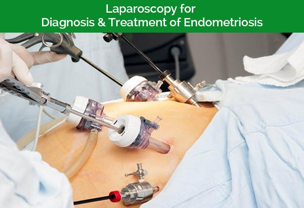Laparoscopy for Diagnosis and Treatment of Endometriosis