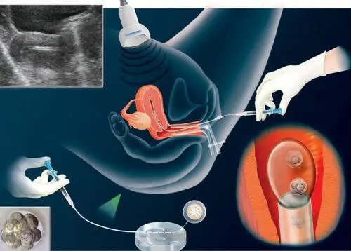 Embryo Transfer Instructions
